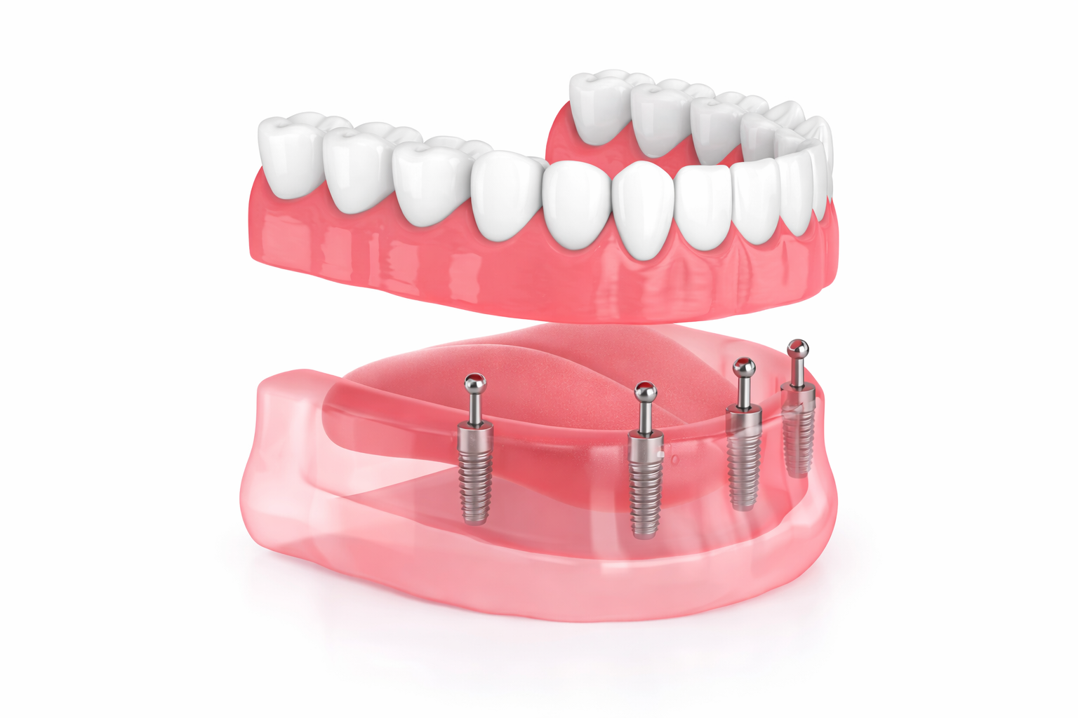 Implant Overdentures