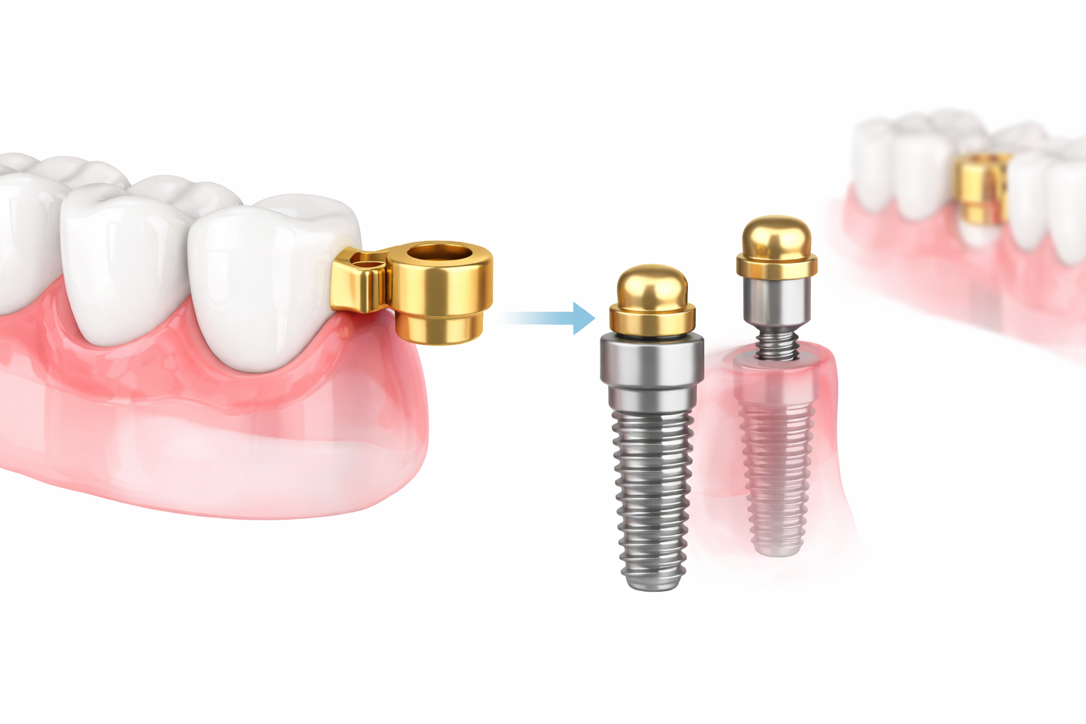 Precision Attachment System